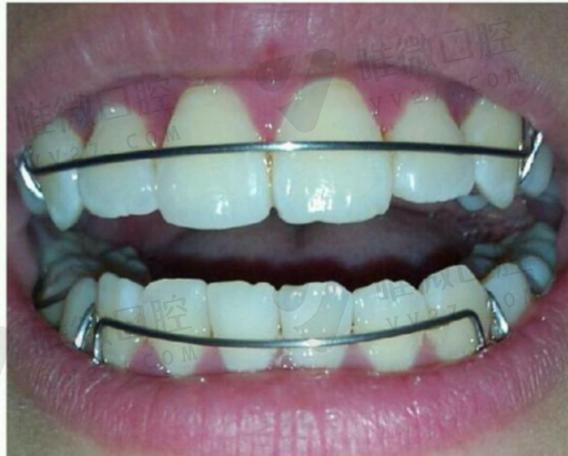 科普,拔牙的注意事项，牙齿松动了自然掉牙还是拔牙好(图1)